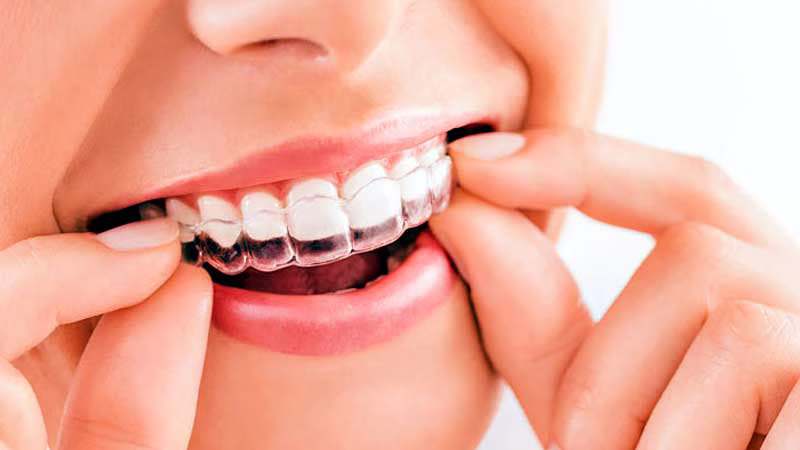 Person placing a transparent clear aligner tray