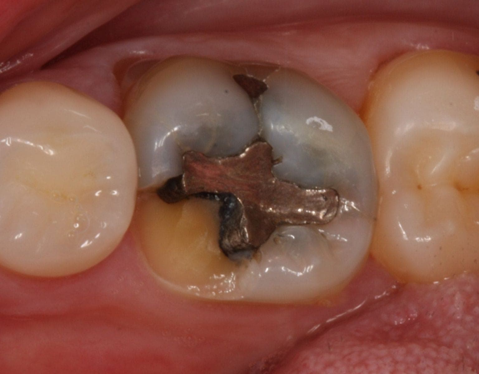 Fractured molar with an old filling