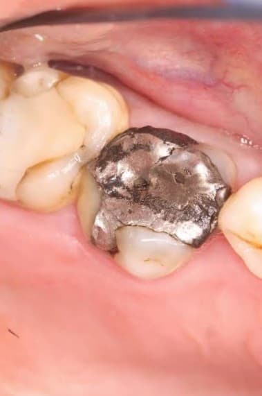 Tooth with a large existing filling that may need dental crown protection