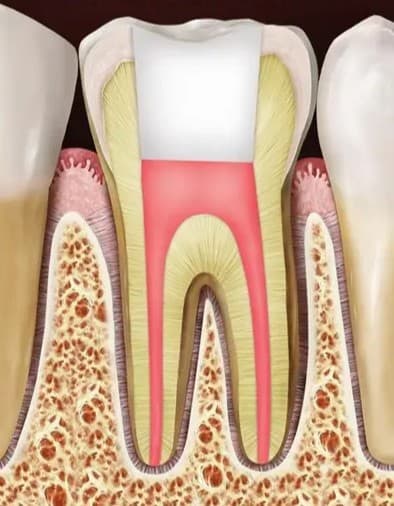 Illustration of a root canal treated tooth