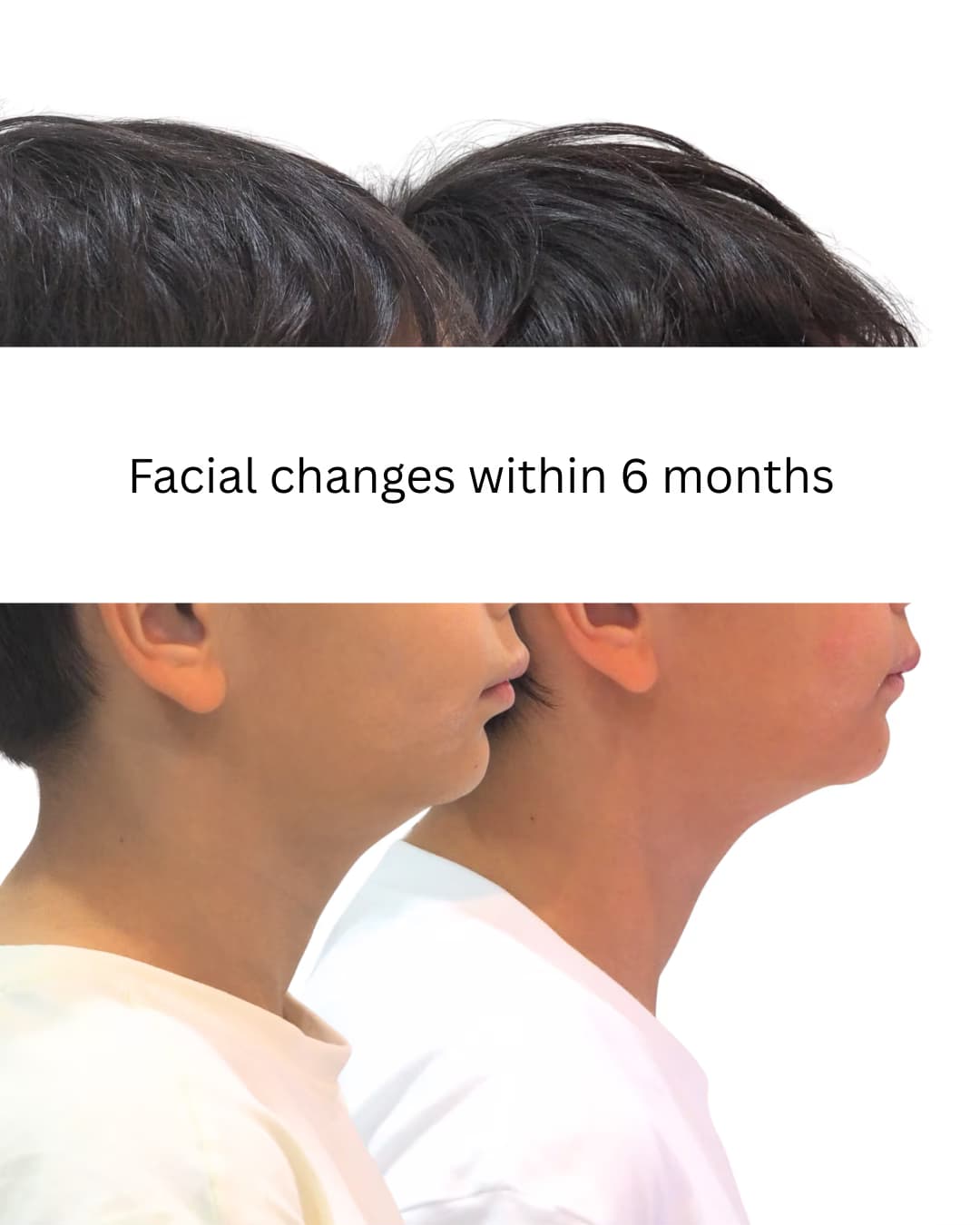 Side profile changes after six months of early bite guidance