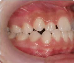 Crossbite in a child's developing teeth