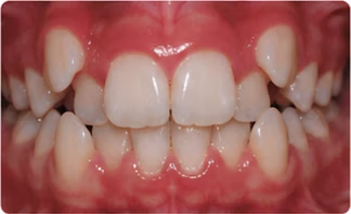 Crowded teeth in a developing bite