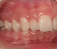 Deep bite in a child's developing teeth
