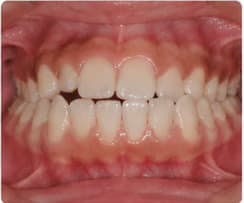 Underbite in a child's developing teeth