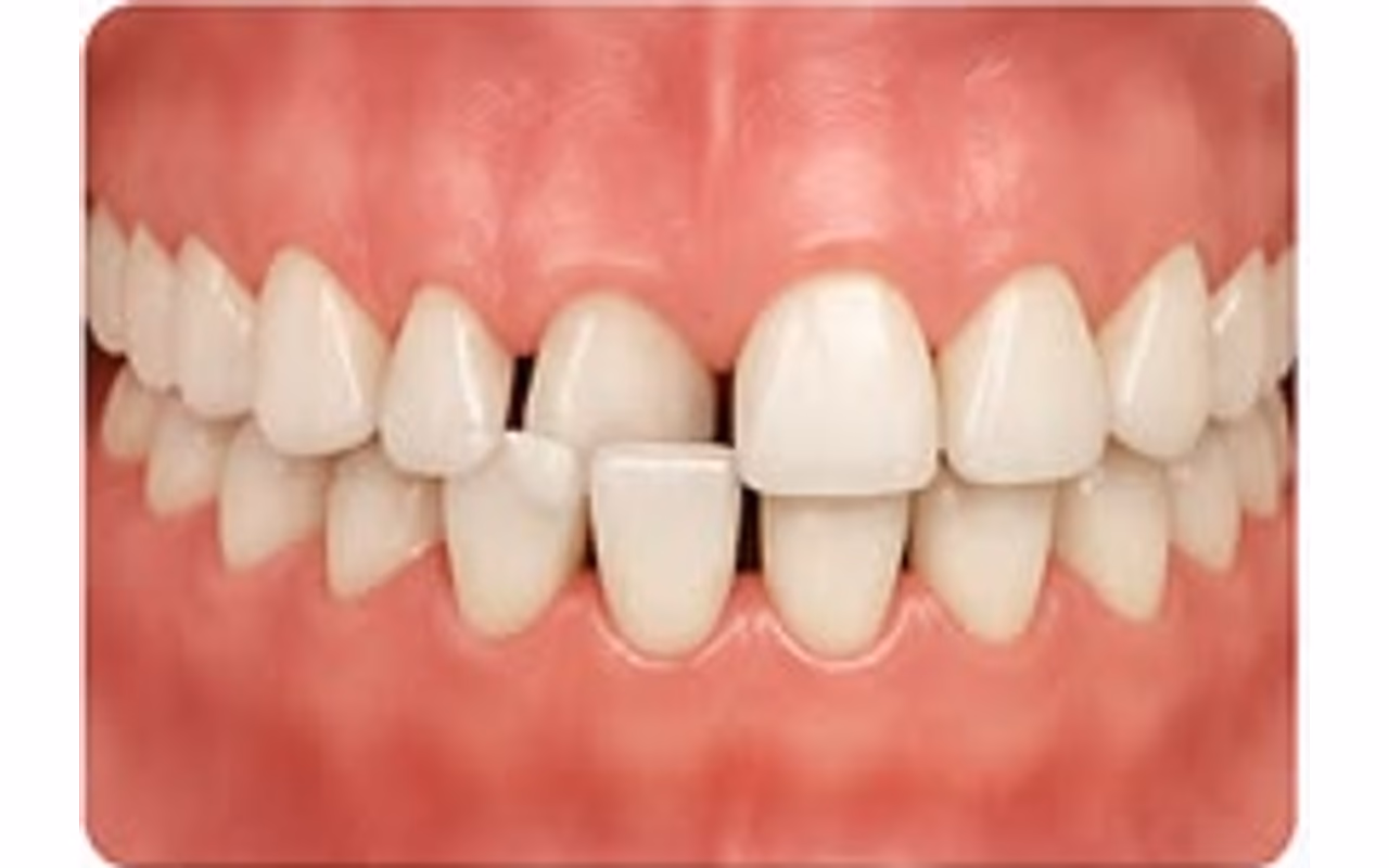 Anterior crossbite affecting the front teeth