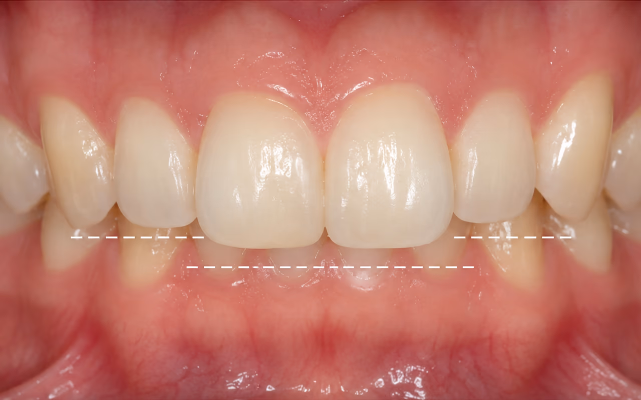 Deep bite with the upper front teeth overlapping the lower teeth