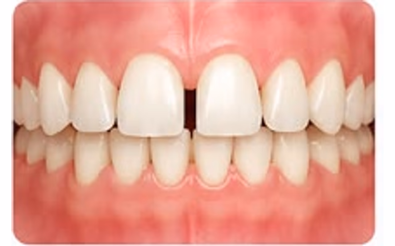 Visible gaps between the upper front teeth