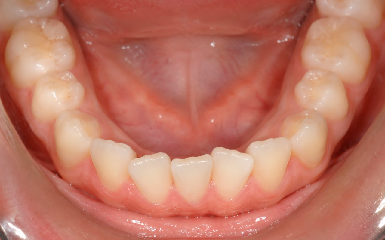 Teeth after braces and after orthodontic relapse