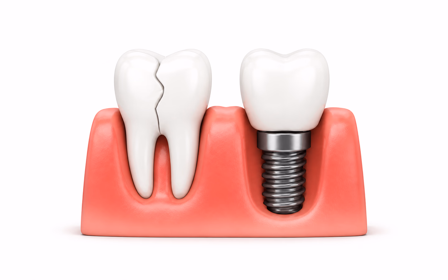 Illustration of a broken tooth beside an implant-supported dental crown