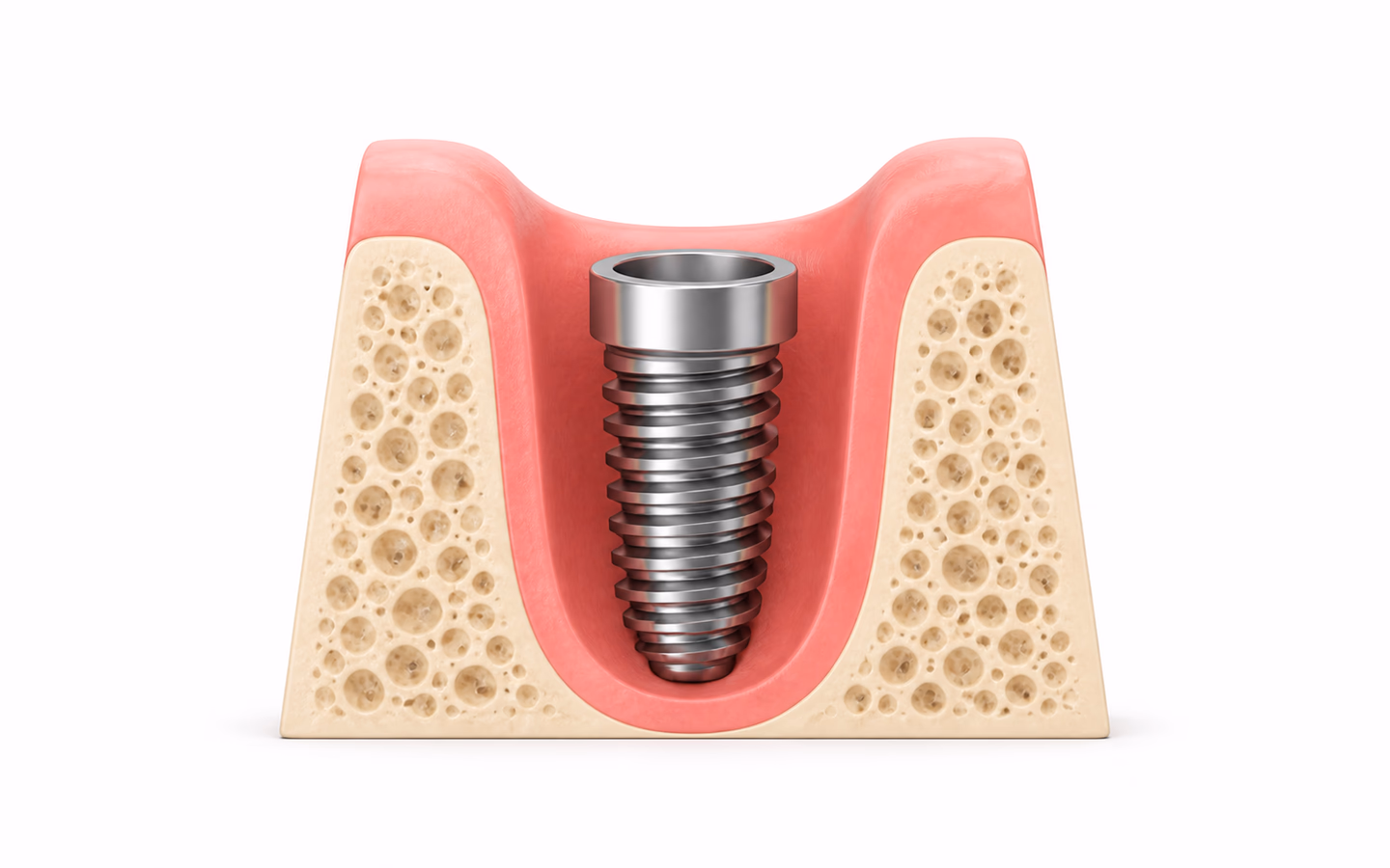 Illustration of a dental implant supported by jaw bone