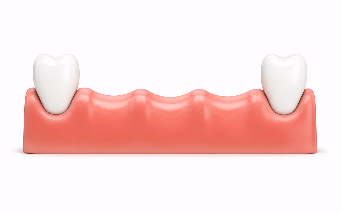Illustration showing multiple missing teeth