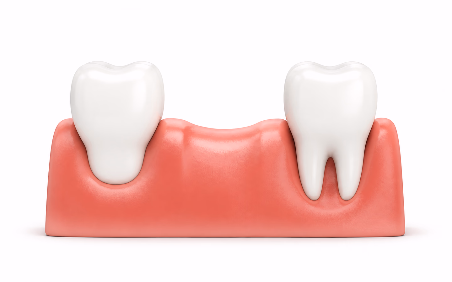 Illustration showing one missing tooth