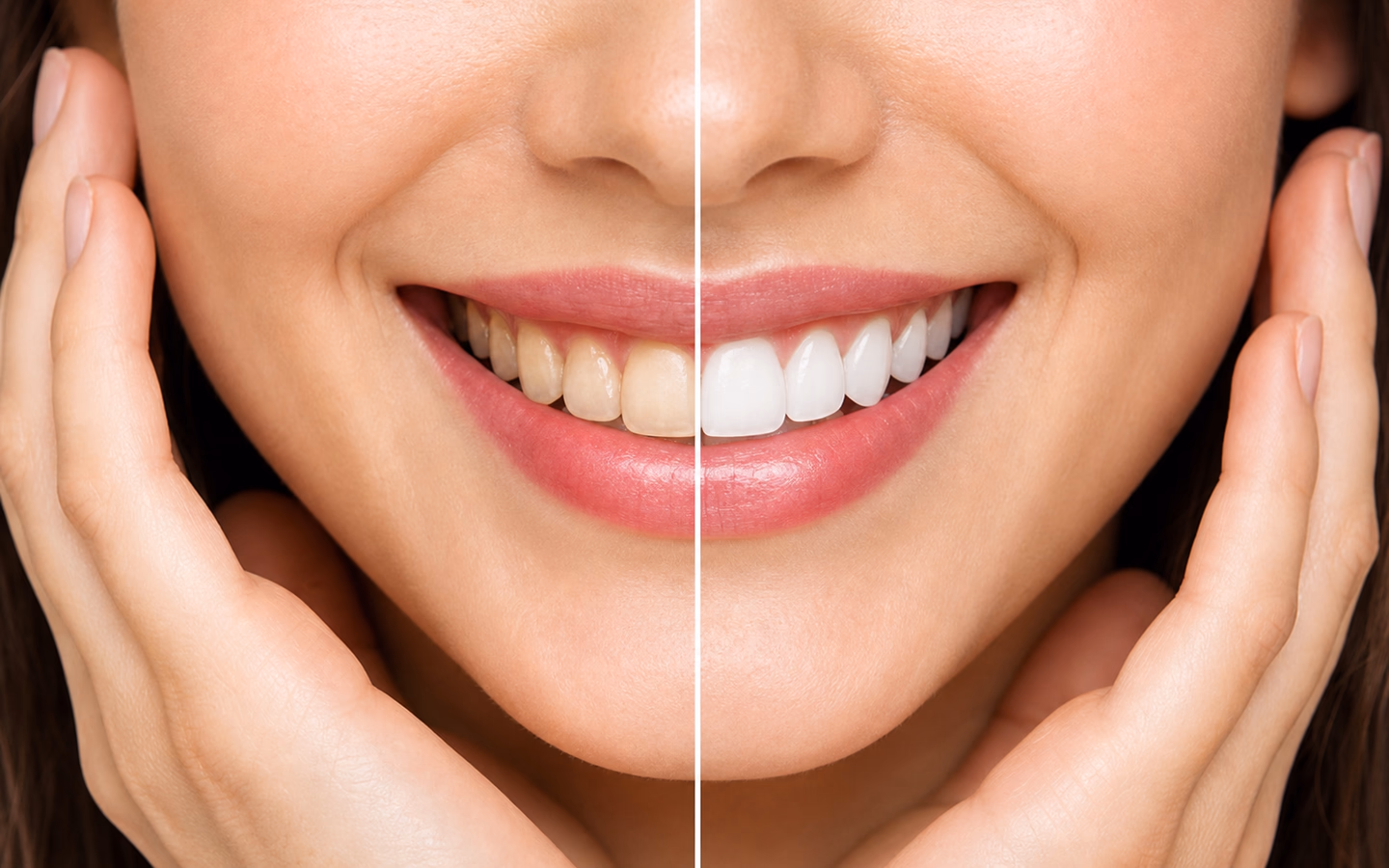Illustrative smile makeover comparison