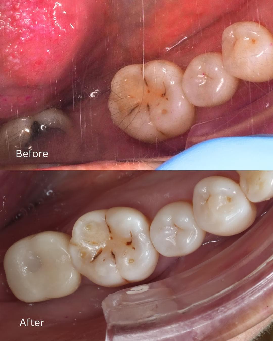 Before and after a custom implant-supported dental crown was fitted