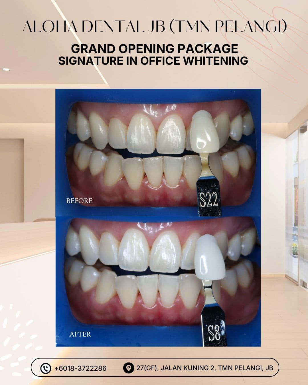 Signature in-office whitening package before and after result at Aloha Dental