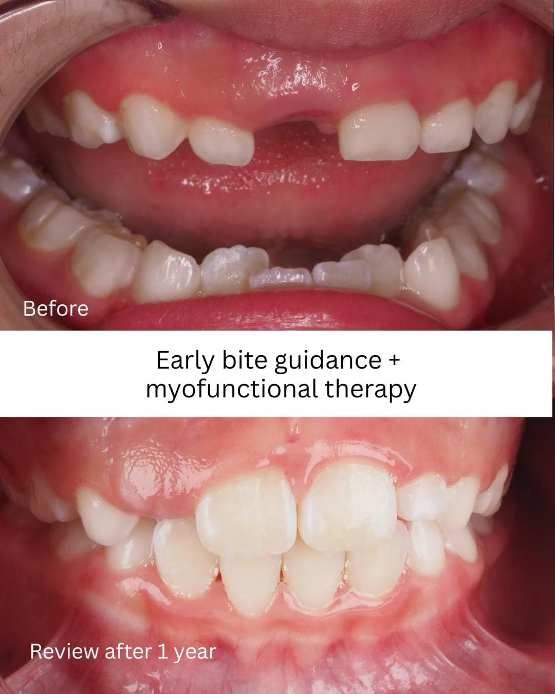 Before and one-year review after early bite guidance and myofunctional therapy