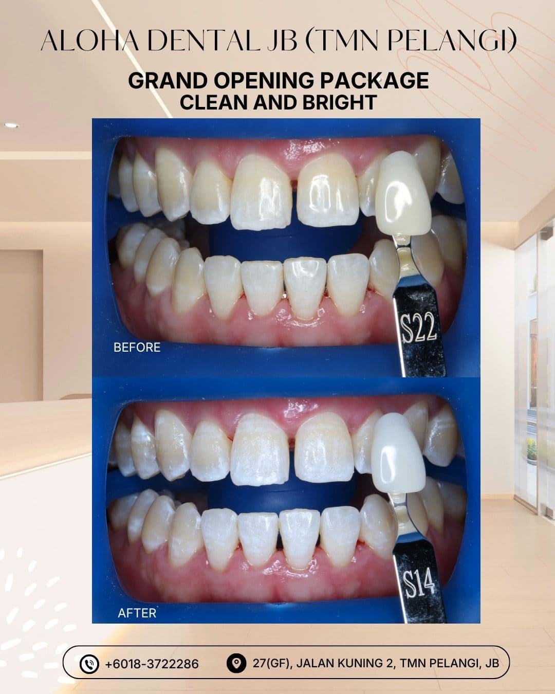 Clean and Bright whitening package before and after result at Aloha Dental