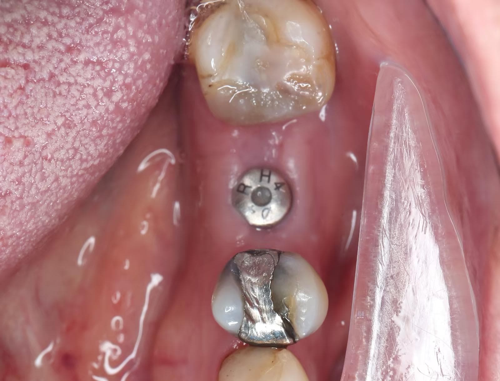 Clinical view after dental implant placement