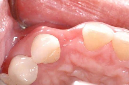 Clinical view showing jaw bone shrinkage after tooth removal