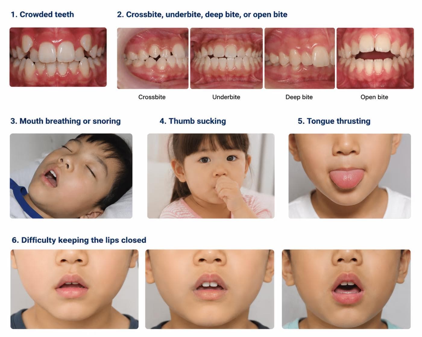 Examples of crowded teeth, bite concerns, mouth breathing, thumb sucking and tongue thrusting in children