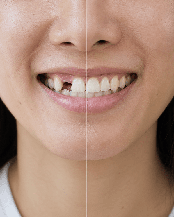Missing Tooth Replacement