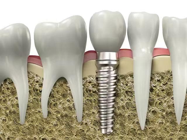 Illustration of a dental implant replacing a missing tooth root